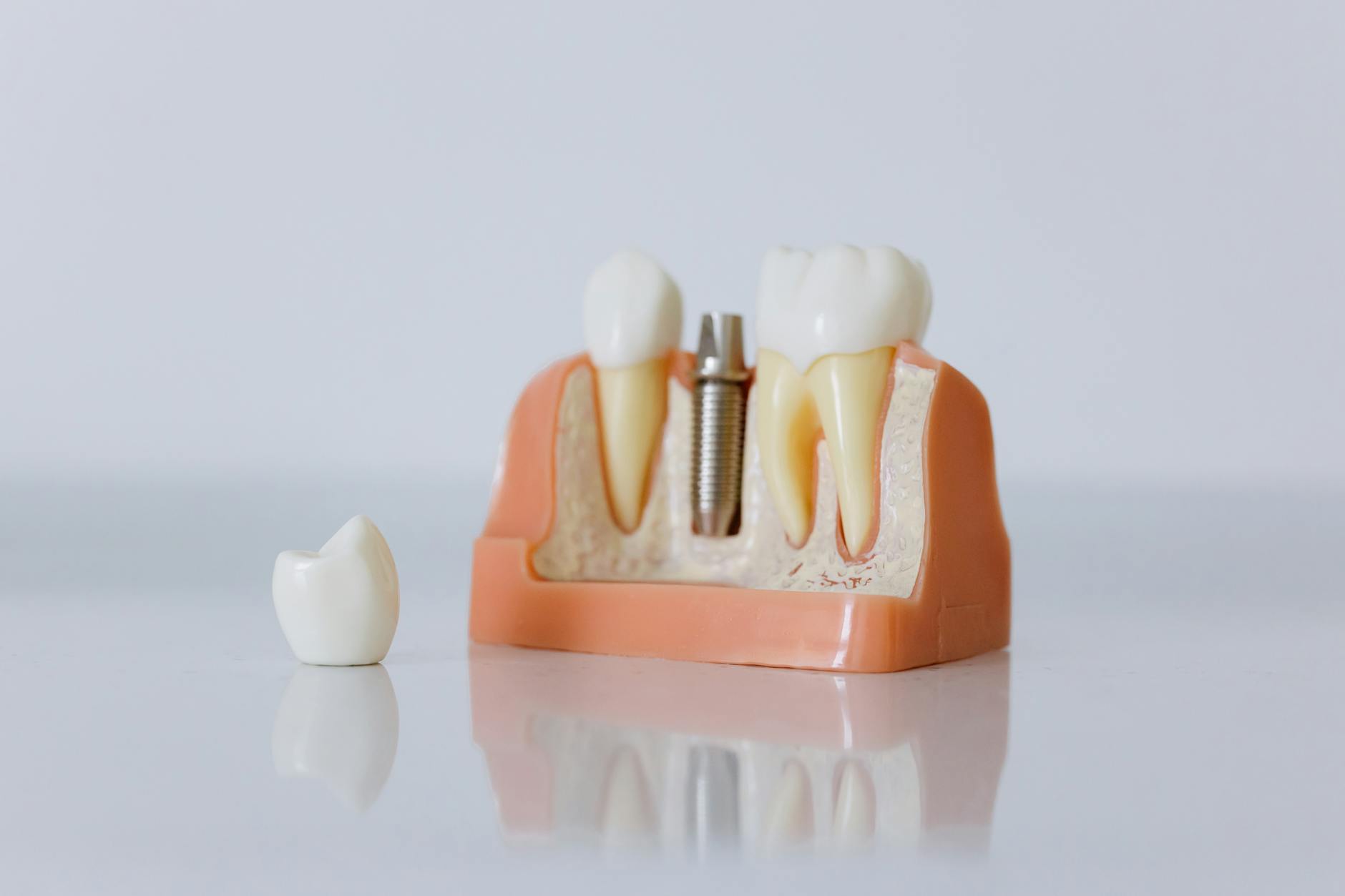 Implanturi Dentare